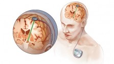 Deep-brain-stimulation-223x126.jpg