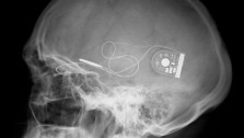alpha-ims-x-ray-retinal-implant-223x126.jpg